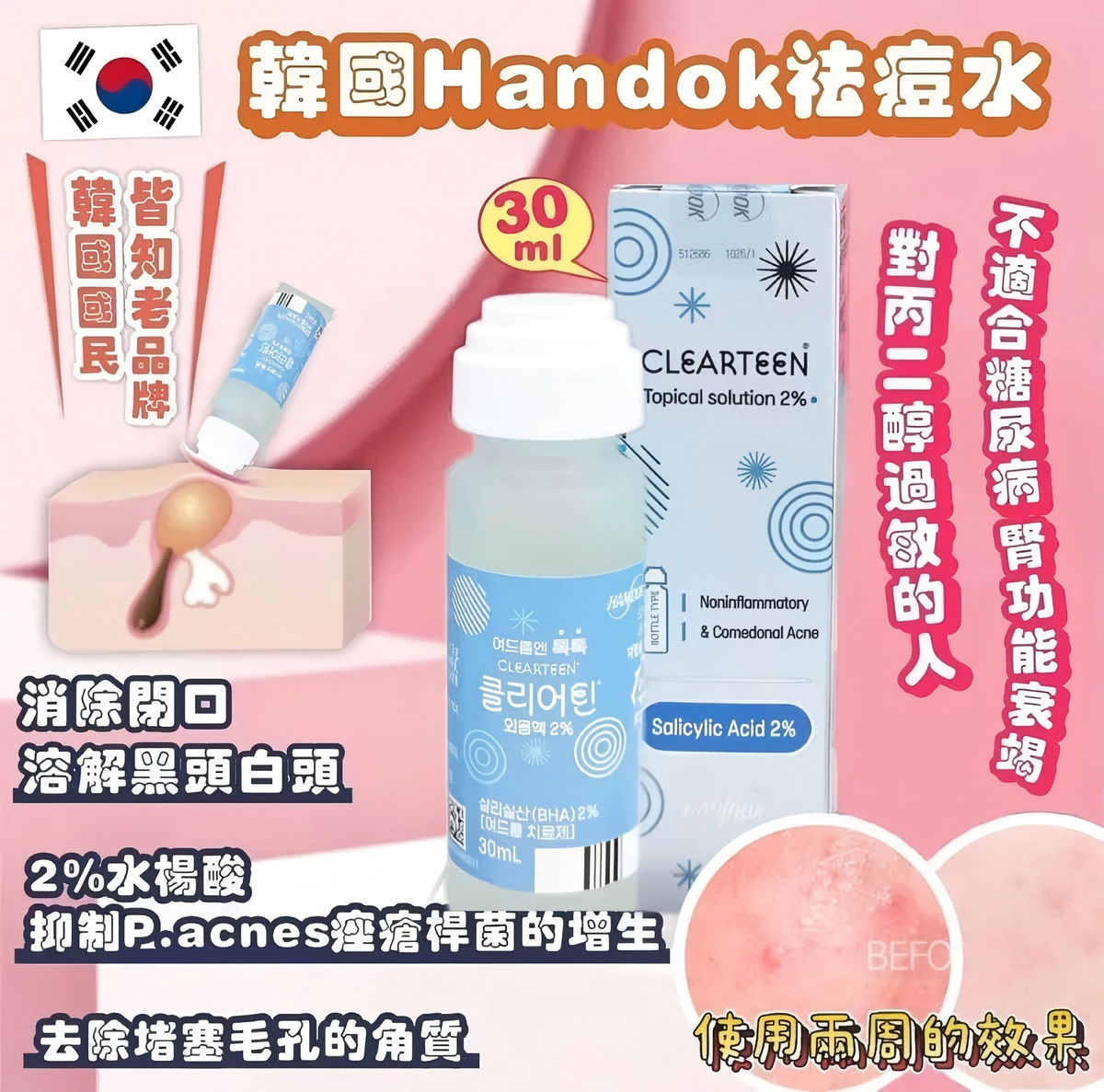 HANDOK - HANDOK 水楊酸祛痘抗粉刺抗痘水  30ml 平行進口
